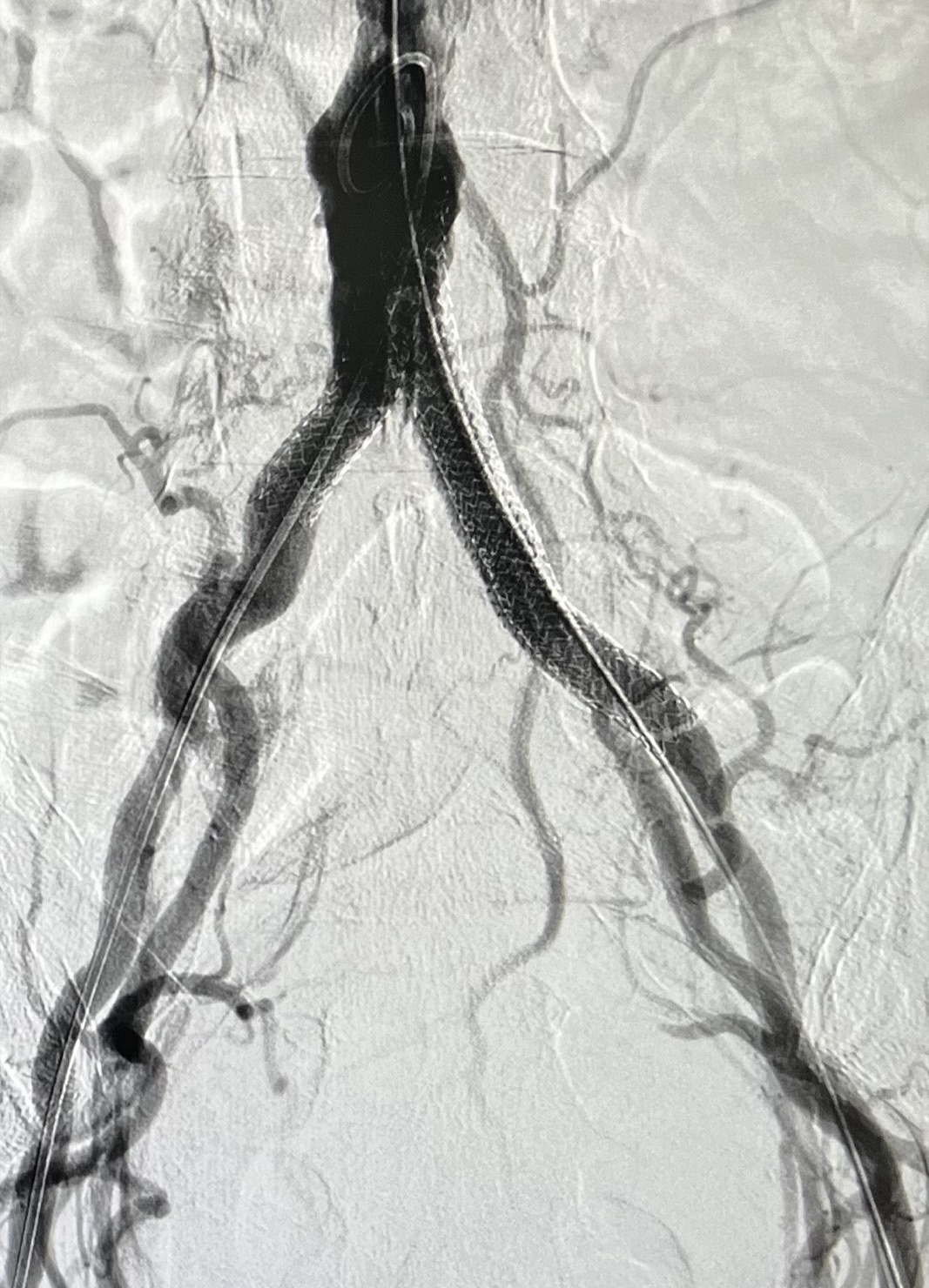 Digital subtraction angiogram after aorto-iliac stent placement
