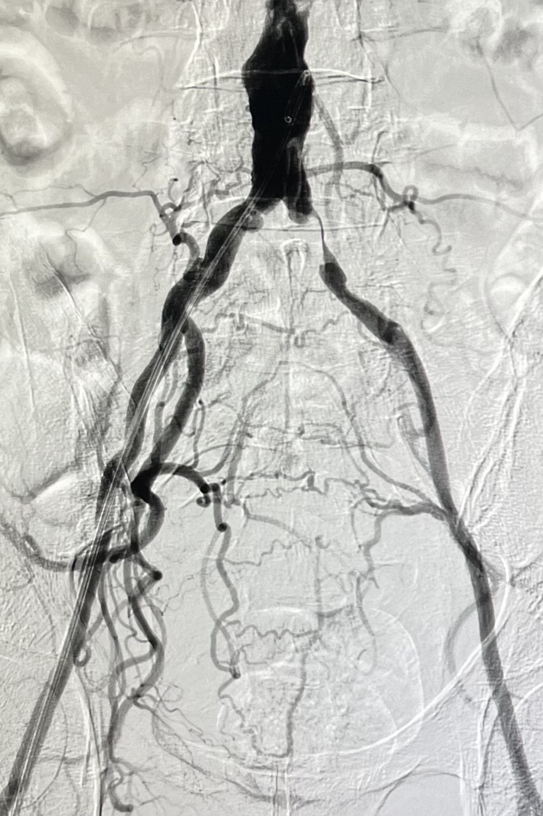 Digital subtraction angiogram of aorto-iliac stenosis